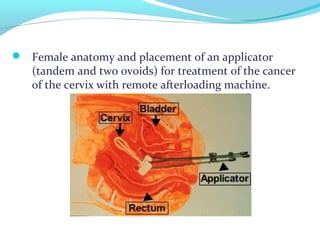  Female anatomy and placement of an applicator
(tandem and two ovoids) for treatment of the cancer
of the cervix with remote afterloading machine.
 