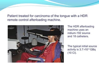 Patient treated for carcinoma of the tongue with a HDR
remote control afterloading machine.
The HDR afterloading
machine uses an
iridium-192 source
and 18 catheters.
The typical initial source
activity is 3.7 1010
GBq
(10 Ci).
×
 