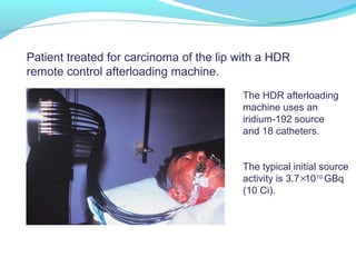 Patient treated for carcinoma of the lip with a HDR
remote control afterloading machine.
The HDR afterloading
machine uses an
iridium-192 source
and 18 catheters.
The typical initial source
activity is 3.7 1010
GBq
(10 Ci).
×
 