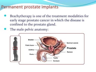 Permanent prostate implants
 Brachytherapy is one of the treatment modalities for
early stage prostate cancer in which the disease is
confined to the prostate gland.
 The male pelvic anatomy:
 