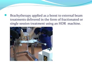  Brachytherapy applied as a boost to external beam
treatments delivered in the form of fractionated or
single session treatment using an HDR machine.
 