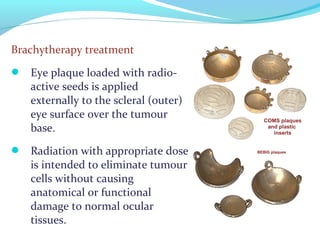 Brachytherapy treatment
 Eye plaque loaded with radio-
active seeds is applied
externally to the scleral (outer)
eye surface over the tumour
base.
 Radiation with appropriate dose
is intended to eliminate tumour
cells without causing
anatomical or functional
damage to normal ocular
tissues.
 