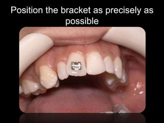 Use a mirror to verify if the bracket is
centered on the crown
 