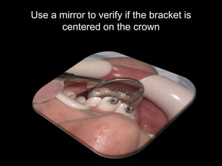Excess composite
Remove excess composite around the
bracket with a scaler or an explorer before
light curing. If not, it w...