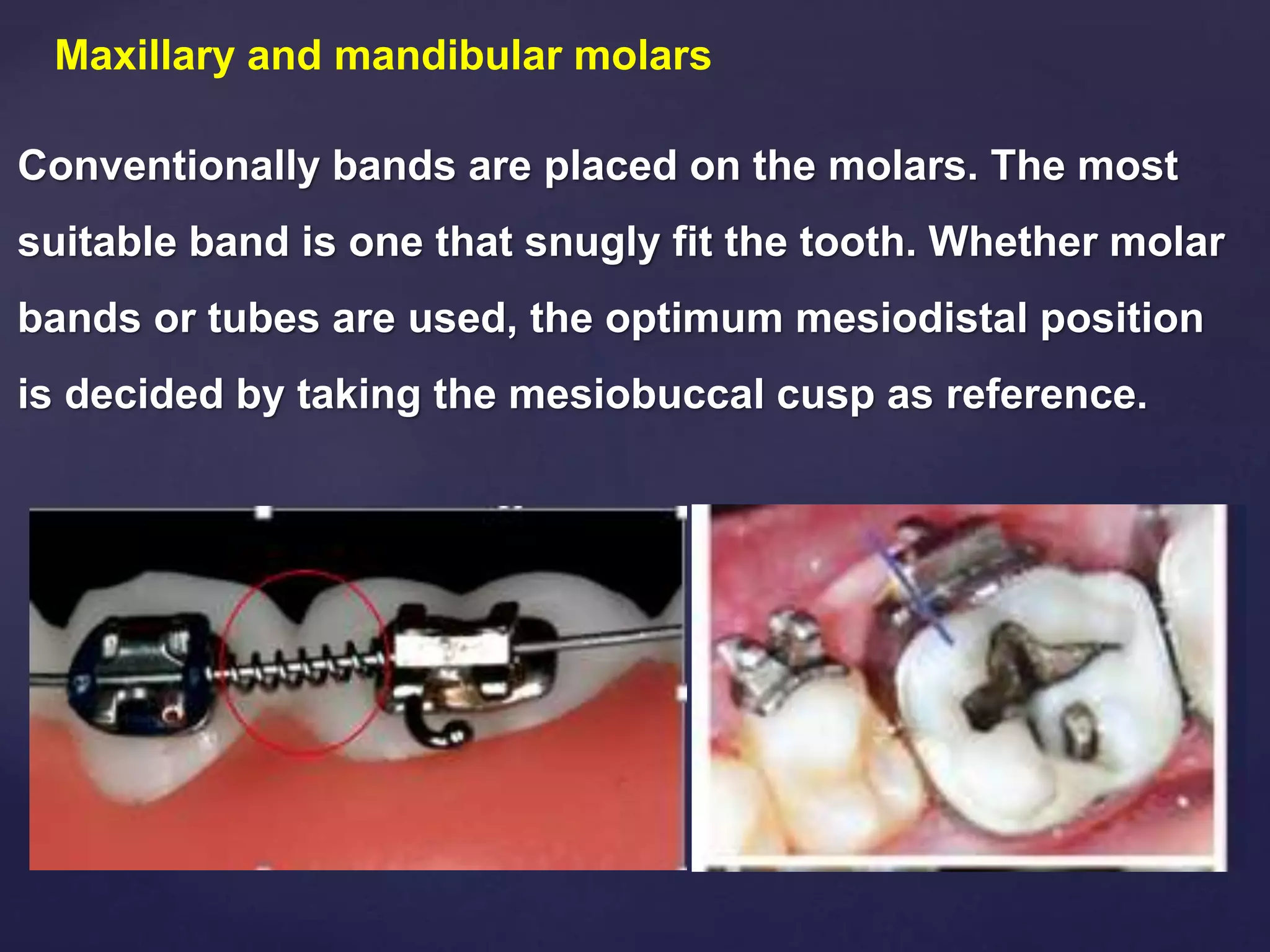 placement of orthodontic brackets | PPTX