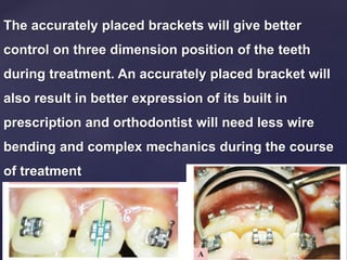 The accurately placed brackets will give better
control on three dimension position of the teeth
during treatment. An accurately placed bracket will
also result in better expression of its built in
prescription and orthodontist will need less wire
bending and complex mechanics during the course
of treatment
 