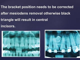 The bracket position needs to be corrected
after mesiodens removal otherwise black
triangle will result in central
incisors.
 