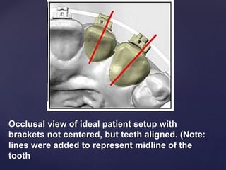 Occlusal view of ideal patient setup with
brackets not centered, but teeth aligned. (Note:
lines were added to represent midline of the
tooth.
 
