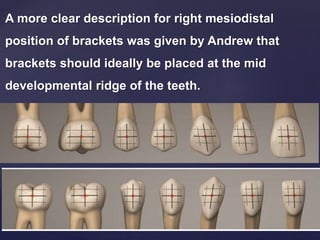 A more clear description for right mesiodistal
position of brackets was given by Andrew that
brackets should ideally be placed at the mid
developmental ridge of the teeth.
 