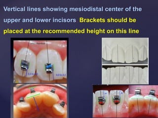 Vertical lines showing mesiodistal center of the
upper and lower incisors. Brackets should be
placed at the recommended height on this line
 