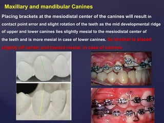 Maxillary and mandibular Canines
Placing brackets at the mesiodistal center of the canines will result in
contact point error and slight rotation of the teeth as the mid developmental ridge
of upper and lower canines lies slightly mesial to the mesiodistal center of
the teeth and is more mesial in case of lower canines. So bracket is placed
slightly off center and toward mesial, in case of canines
 