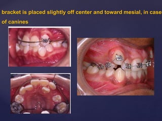 bracket is placed slightly off center and toward mesial, in case
of canines
 