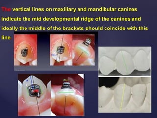 {
The vertical lines on maxillary and mandibular canines
indicate the mid developmental ridge of the canines and
ideally the middle of the brackets should coincide with this
line.
 