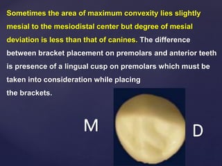 Sometimes the area of maximum convexity lies slightly
mesial to the mesiodistal center but degree of mesial
deviation is less than that of canines. The difference
between bracket placement on premolars and anterior teeth
is presence of a lingual cusp on premolars which must be
taken into consideration while placing
the brackets.
M D
 