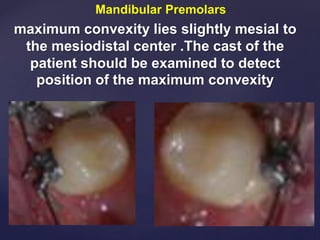 Mandibular Premolars
maximum convexity lies slightly mesial to
the mesiodistal center .The cast of the
patient should be examined to detect
position of the maximum convexity
 