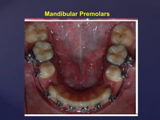 Mandibular Premolars
 