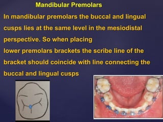 In mandibular premolars the buccal and lingual
cusps lies at the same level in the mesiodistal
perspective. So when placing
lower premolars brackets the scribe line of the
bracket should coincide with line connecting the
buccal and lingual cusps
Mandibular Premolars
 