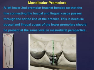 A left lower 2nd premolar bracket bonded so that the
line connecting the buccal and lingual cusps passes
through the scribe line of the bracket. This is because
buccal and lingual cusps of the lower premolars should
be present at the same level in mesiodistal perspective
Mandibular Premolars
 