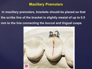 In maxillary premolars, brackets should be placed so that
the scribe line of the bracket is slightly mesial of up to 0.5
mm to the line connecting the buccal and lingual cusps
 