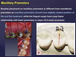 Maxillary Premolars
Bracket placement on maxillary premolars is different from mandibular
premolars as maxillary premolars should have slightly rotated position at
the end the treatment. while the lingual cusps have cusp fossa
relationship with lower premolars in class I & II molar occlusion
 