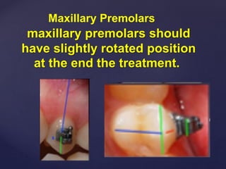 Maxillary Premolars
maxillary premolars should
have slightly rotated position
at the end the treatment.
 