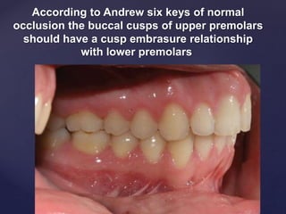 According to Andrew six keys of normal
occlusion the buccal cusps of upper premolars
should have a cusp embrasure relationship
with lower premolars
 