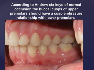 According to Andrew six keys of normal
occlusion the buccal cusps of upper
premolars should have a cusp embrasure
relationship with lower premolars
 