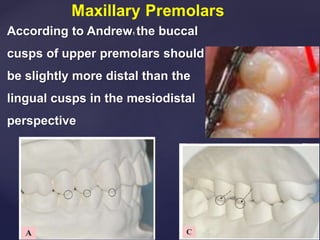 According to Andrew1 the buccal
cusps of upper premolars should
be slightly more distal than the
lingual cusps in the mesiodistal
perspective
 