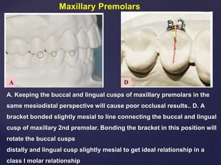 A. Keeping the buccal and lingual cusps of maxillary premolars in the
same mesiodistal perspective will cause poor occlusal results.. D. A
bracket bonded slightly mesial to line connecting the buccal and lingual
cusp of maxillary 2nd premolar. Bonding the bracket in this position will
rotate the buccal cusps
distally and lingual cusp slightly mesial to get ideal relationship in a
class I molar relationship
 