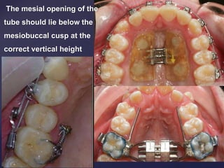 {
The mesial opening of the
tube should lie below the
mesiobuccal cusp at the
correct vertical height
 