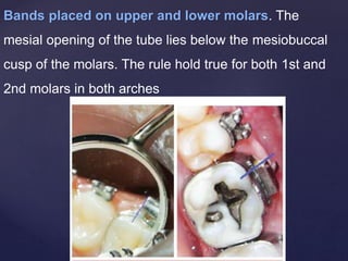Bands placed on upper and lower molars. The
mesial opening of the tube lies below the mesiobuccal
cusp of the molars. The rule hold true for both 1st and
2nd molars in both arches
 