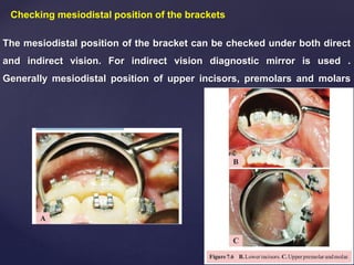Checking mesiodistal position of the brackets
The mesiodistal position of the bracket can be checked under both direct
and indirect vision. For indirect vision diagnostic mirror is used .
Generally mesiodistal position of upper incisors, premolars and molars
brackets is
checked under indirect vision
 
