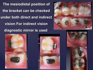 The mesiodistal position of
the bracket can be checked
under both direct and indirect
vision For indirect vision
diagnostic mirror is used
 
