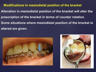 Modifications in mesiodistal position of the bracket
Alteration in mesiodistal position of the bracket will alter the
prescription of the bracket in terms of counter rotation.
Some situations where mesiodistal position of the bracket is
altered are given.
 