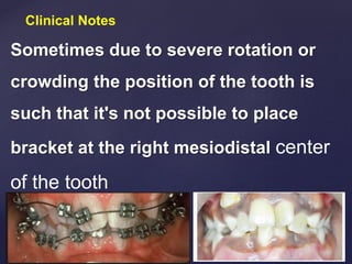 Clinical Notes
Sometimes due to severe rotation or
crowding the position of the tooth is
such that it's not possible to place
bracket at the right mesiodistal center
of the tooth
 