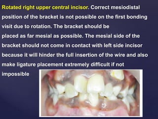 Rotated right upper central incisor. Correct mesiodistal
position of the bracket is not possible on the first bonding
visit due to rotation. The bracket should be
placed as far mesial as possible. The mesial side of the
bracket should not come in contact with left side incisor
because it will hinder the full insertion of the wire and also
make ligature placement extremely difficult if not
impossible
 