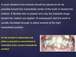In such situations the bracket should be placed as far as
possible toward the mesiodistal center of the tooth or toward the
rotation. A flexible wire is passed and only the brackets wings
toward the rotation are ligated. At subsequent visit the tooth is
usually derotated enough to place bracket at the right
mesiodistal position
So the bracket is debonded and
either a recycled or new bracket is
rebonded at the correct mesiodistal
position
 