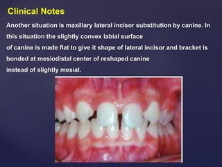 Clinical Notes
Another situation is maxillary lateral incisor substitution by canine. In
this situation the slightly convex labial surface
of canine is made flat to give it shape of lateral incisor and bracket is
bonded at mesiodistal center of reshaped canine
instead of slightly mesial.
 