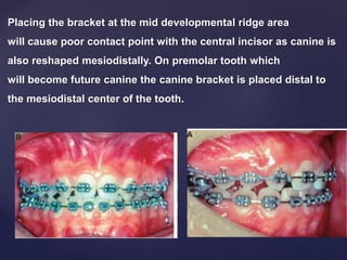 Placing the bracket at the mid developmental ridge area
will cause poor contact point with the central incisor as canine is
also reshaped mesiodistally. On premolar tooth which
will become future canine the canine bracket is placed distal to
the mesiodistal center of the tooth.
 