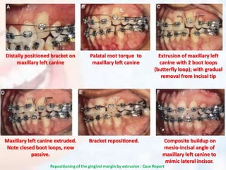 Palatal root torque to
maxillary left canine
Extrusion of maxillary left
canine with 2 boot loops
(butterfly loop); with gradual
removal from incisal tip
Composite buildup on
mesio-incisal angle of
maxillary left canine to
mimic lateral incisor.
Distally positioned bracket on
maxillary left canine
Maxillary left canine extruded.
Note closed boot loops, now
passive.
Bracket repositioned.
Repositioning of the gingival margin by extrusion : Case Report
 