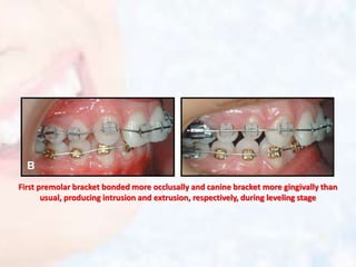 First premolar bracket bonded more occlusally and canine bracket more gingivally than
usual, producing intrusion and extrusion, respectively, during leveling stage
 
