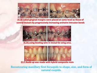 (A,B) Labial gingival margins were placed at same level as those of
central incisors by progressively increasing archwire intrusion bends
(E,F) Build-up was made with hybrid composite resin
(C,D).using leveling wire in incisal tie-wing area.
Recontouring maxillary first bicuspids to shape, size, and form of
natural cuspids.
 
