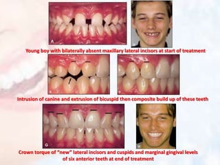 Young boy with bilaterally absent maxillary lateral incisors at start of treatment
Intrusion of canine and extrusion of bicuspid then composite build up of these teeth
Crown torque of “new” lateral incisors and cuspids and marginal gingival levels
of six anterior teeth at end of treatment
 