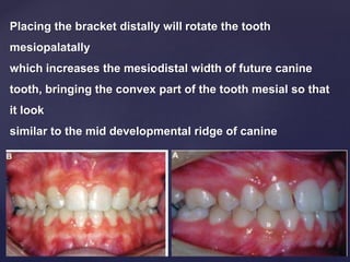 Placing the bracket distally will rotate the tooth
mesiopalatally
which increases the mesiodistal width of future canine
tooth, bringing the convex part of the tooth mesial so that
it look
similar to the mid developmental ridge of canine
 