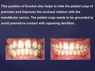 This position of bracket also helps to hide the palatal cusp of
premolar and improves the occlusal relation with the
mandibular canine. The palatal cusp needs to be grounded to
avoid premature contact with opposing dentition.
 