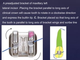 A preadjusted bracket of maxillary left
lateral incisor .Placing the bracket parallel to long axis of
clinical crown will cause tooth to rotate in a clockwise direction
and express the builtin tip. C. Bracket placed so that long axis of
the tooth is parallel to long axis of bracket wings and scribe line
 