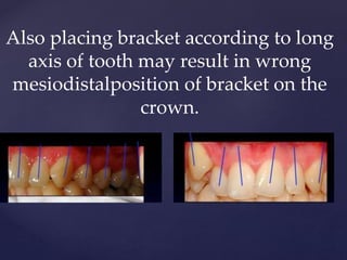 Also placing bracket according to long
axis of tooth may result in wrong
mesiodistalposition of bracket on the
crown.
 