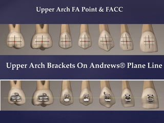 Upper Arch FA Point & FACC
Upper Arch Brackets On Andrews® Plane Line
 
