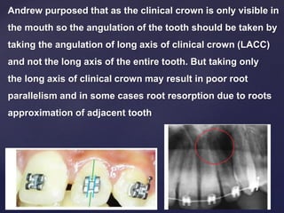 Andrew purposed that as the clinical crown is only visible in
the mouth so the angulation of the tooth should be taken by
taking the angulation of long axis of clinical crown (LACC)
and not the long axis of the entire tooth. But taking only
the long axis of clinical crown may result in poor root
parallelism and in some cases root resorption due to roots
approximation of adjacent tooth
 