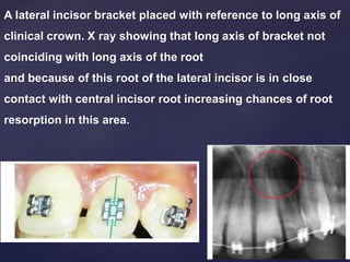 A lateral incisor bracket placed with reference to long axis of
clinical crown. X ray showing that long axis of bracket not
coinciding with long axis of the root
and because of this root of the lateral incisor is in close
contact with central incisor root increasing chances of root
resorption in this area.
 